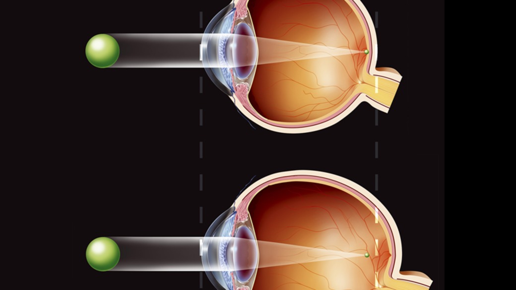 Близорукость. Способы коррекции близорукости и дальнозоркости. Строение глаза человека астигматизм. Близорукость и дальнозоркость. Миопия дальнозоркость астигматизм.