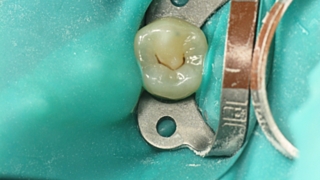 Зуб с пигментацией, которую не надо лечить / Фото: Наталья Чечун