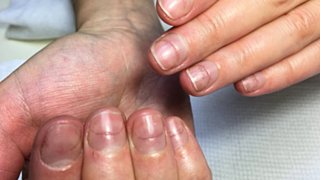 Поврежденные ногти после аппаратного маникюра / Фото: vk.com/@sipailovonails-master-propilila-nogot-otorvat-ruki