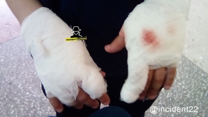 Отмечается, что у ребенка переломаны пальцы, искусаны руки / Фото: www.ap22.ru