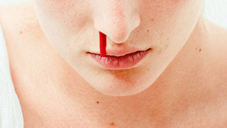 Носовое кровотечение / Фото: unsplash.com