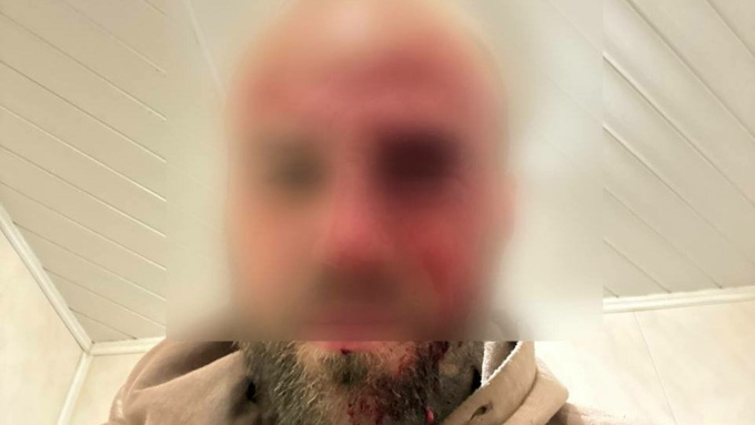 Избитый мужчина / Фото: Barnaul 22