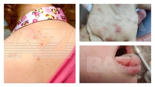 Вирус Коксаки у детей / Фото: Baza