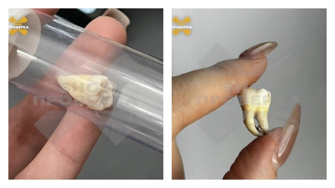 Купленный зуб мудрости / Фото: "Shot Проверка"