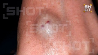 Шишка после укуса насекомого / Фото: Shot