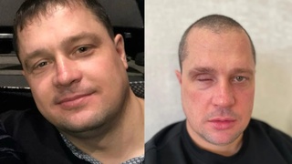Охранник лишился глаза / Фото: Предоставлено потерпевшим для "КП-Новосибирск"