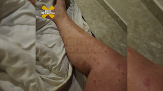 Покусанная нога туристки / Фото: "Shot Проверка"