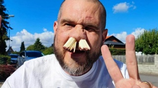 Мужчина со спичками в носу / Фото: "Подъем"