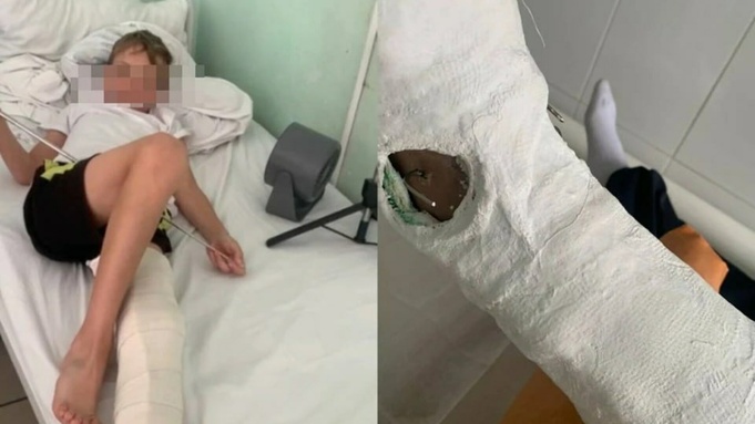 Сбитый мальчик в больнице / Фото: "КП-Барнаул"