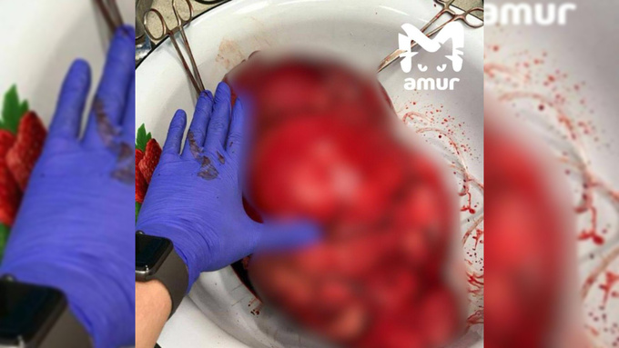 Опухоль с два шара для боулинга / Фото: Amur Mash