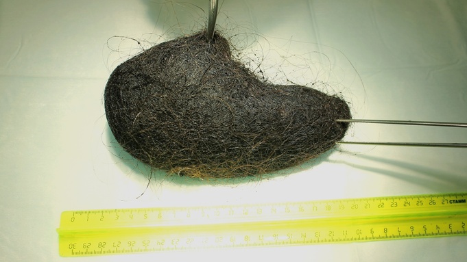 Огромный комок волос / Фото: vk.com/dgkb7barnaul