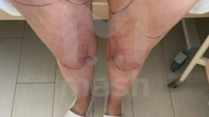 Россиянке грозит ампутация ног / Фото: @mash