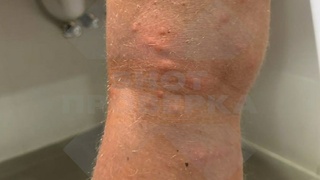 Укусы песчаных мух / Фото: "Shot Проверка"