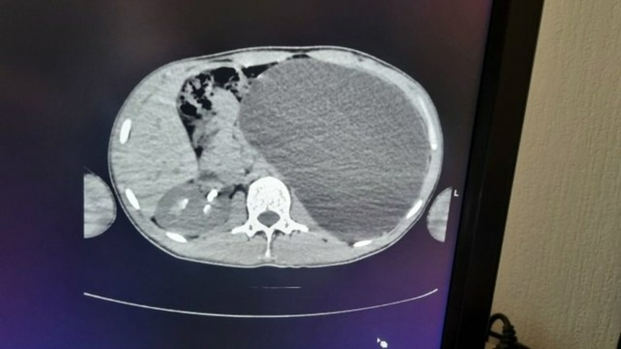 Снимок огромной почки / Фото: Минздрав Новосибирской области