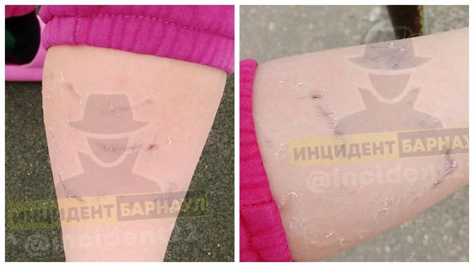 Следы от укусов / Фото: "Инцидент Барнаул"